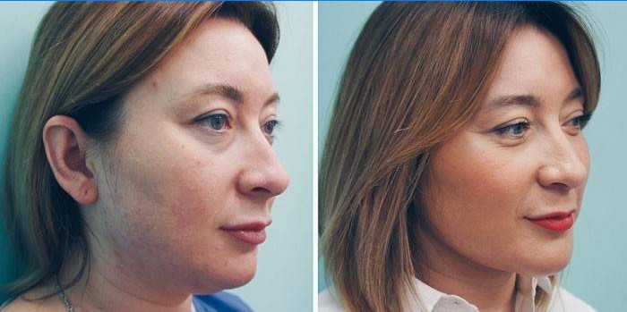 Lipolitik enjeksiyonlardan önce ve sonra kadın