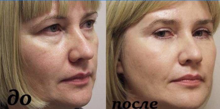 Mezoterapi öncesi ve sonrası yüz